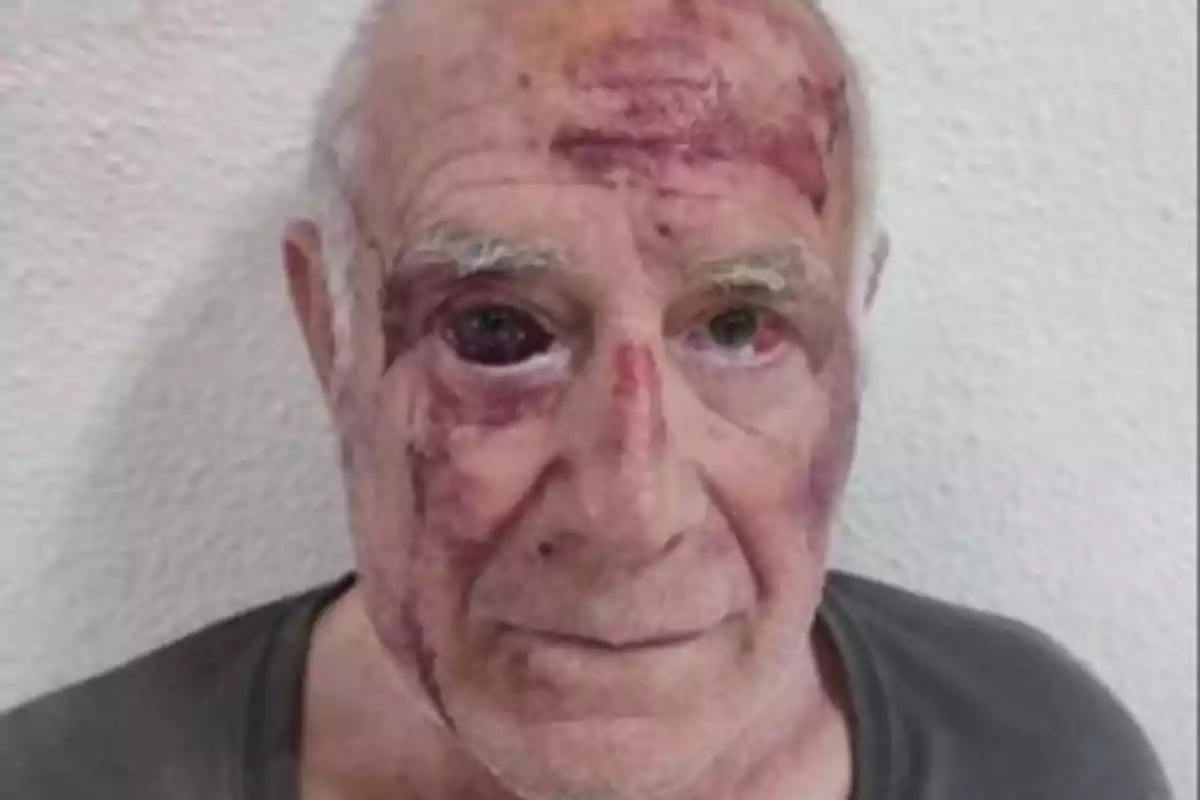 Hombre mayor con heridas y moretones visibles en el rostro frente a una pared blanca Hombre mayor con heridas y moretones visibles en el rostro frente a una pared blanca
