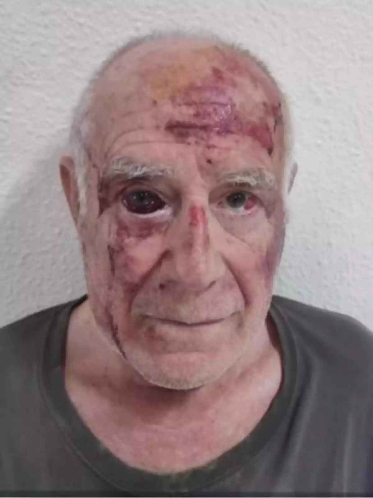 Hombre mayor con heridas y moretones visibles en el rostro, de cabello canoso y camiseta oscura, frente a una pared blanca. Hombre mayor con heridas y moretones visibles en el rostro, de cabello canoso y camiseta oscura, frente a una pared blanca.