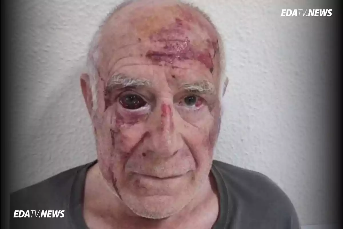 Hombre mayor con heridas visibles en el rostro y moretones en la frente y alrededor de los ojos, de pie frente a una pared blanca. Hombre mayor con heridas visibles en el rostro y moretones en la frente y alrededor de los ojos, de pie frente a una pared blanca.