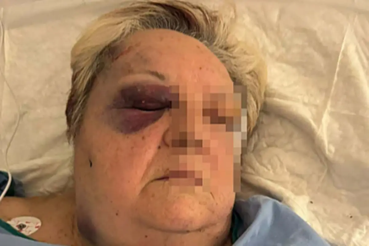 Mujer mayor en cama de hospital con el rostro parcialmente pixelado y un ojo muy amoratado y cerrado