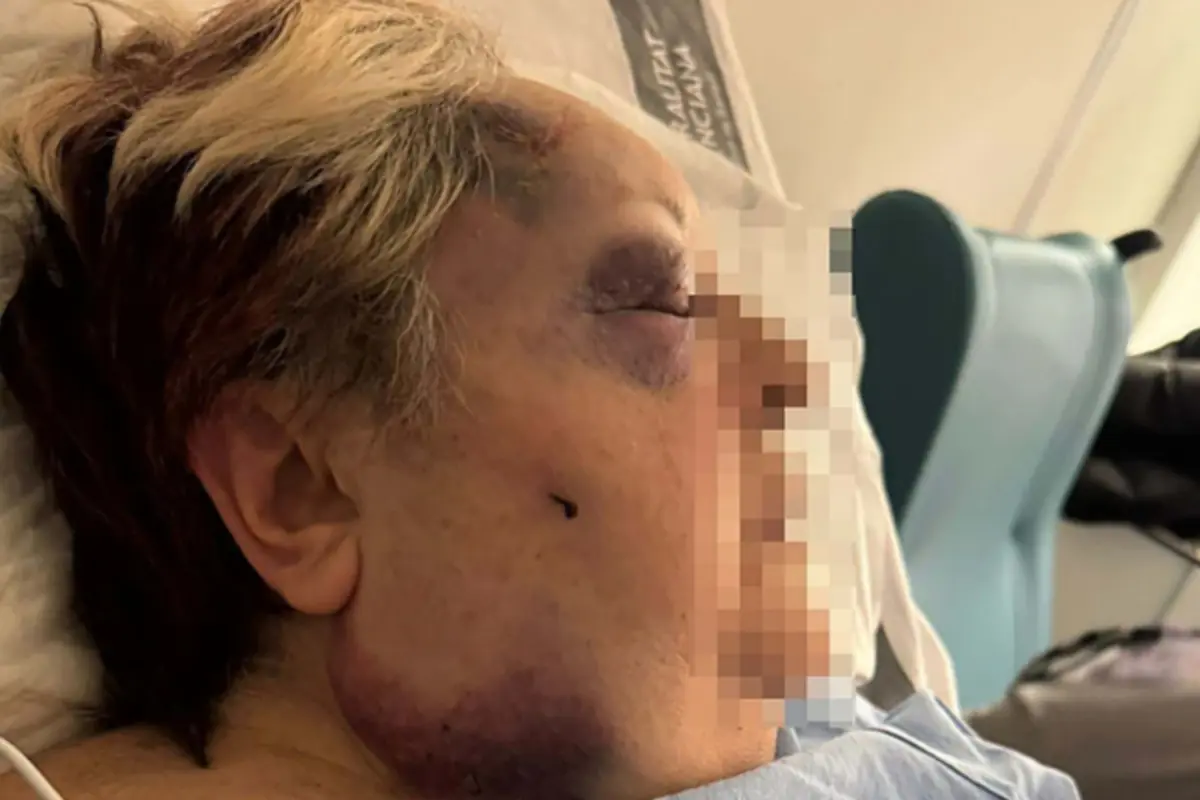 Persona mayor tumbada en una camilla con el rostro pixelado y visibles hematomas en el ojo y la mandíbula