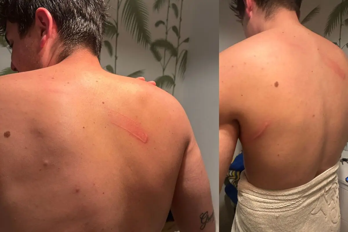 Espalda de un hombre con varias marcas rojas alargadas y recientes en la piel mientras está de pie en un baño con toalla y pared decorada con hojas de palma Espalda de un hombre con varias marcas rojas alargadas y recientes en la piel mientras está de pie en un baño con toalla y pared decorada con hojas de palma