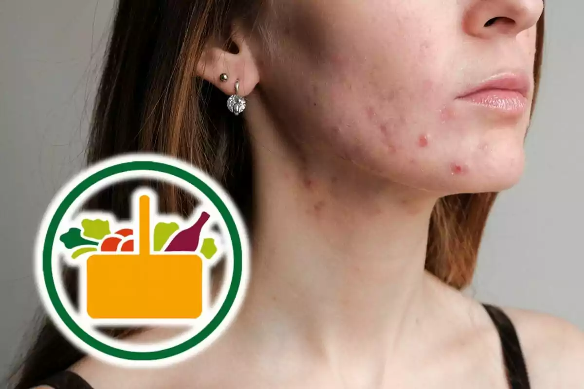 Una persona con acné en el rostro y el logo de Mercadona al lado. Una persona con acné en el rostro y el logo de Mercadona al lado.